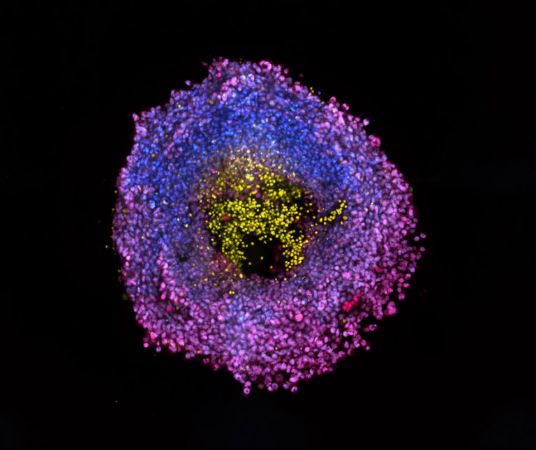 tumor microenvironment